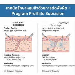 เทคนิครักษาหลุมสิว ด้วยการตัดพังผืดหลุมสิวเทคนิค Program Profhilo Bio-Remodeling Fanning Subcision Techniques for Acne Scar Treatment