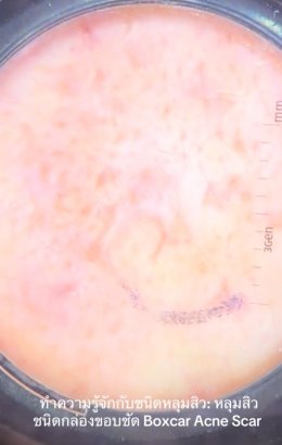 ทำความรู้จักชนิดหลุมสิว: Rolling, Boxcar และ Ice Pick Acne Scar