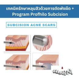 เทคนิครักษาหลุมสิว ด้วยการตัดพังผืดหลุมสิวเทคนิค Program Profhilo Bio-Remodeling Fanning Subcision Techniques for Acne Scar Treatment