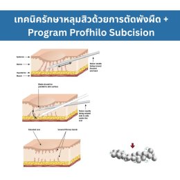 เทคนิครักษาหลุมสิว ด้วยการตัดพังผืดหลุมสิวเทคนิค Program Profhilo Bio-Remodeling Fanning Subcision Techniques for Acne Scar Treatment