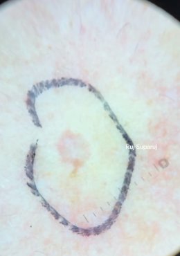 "แผลเป็นหลุมอีสุกอีใส" (Chicken Pox Scars) ลักษณะเฉพาะและการรักษา ?