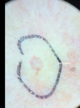 "แผลเป็นหลุมอีสุกอีใส" (Chicken Pox Scars) ลักษณะเฉพาะและการรักษา ?