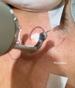 "แผลเป็นหลุมอีสุกอีใส" (Chicken Pox Scars) ลักษณะเฉพาะและการรักษา ?