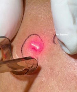 "แผลเป็นหลุมอีสุกอีใส" (Chicken Pox Scars) ลักษณะเฉพาะและการรักษา ?