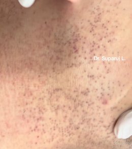 ขนคุดชนิดที่มีรอยแดง Keratosis Pilaris Rubra = KP Rubra มีลักษณะอย่างไร & ดูแลได้อย่างไร ?