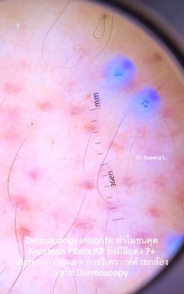 "ทำไมขนคุด Keratosis Pilaris (KP) ถึงมีสีแดง? + แนวทางการดูแล + วิเคราะห์ผิวกล้องส่องขยาย Dermoscopy " วันนี้หมอจะพามาวิเคราะห์ด้วยกล้องขยายผิวหนังหรือ Dermoscopy กันครับ