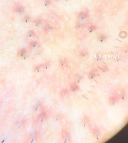 ขนคุดชนิดที่มีรอยแดง Keratosis Pilaris Rubra = KP Rubra มีลักษณะอย่างไร & ดูแลได้อย่างไร ?