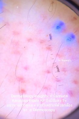"ทำไมขนคุด Keratosis Pilaris (KP) ถึงมีสีแดง? + แนวทางการดูแล + วิเคราะห์ผิวกล้องส่องขยาย Dermoscopy " วันนี้หมอจะพามาวิเคราะห์ด้วยกล้องขยายผิวหนังหรือ Dermoscopy กันครับ