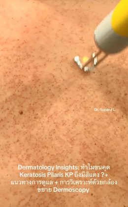 "ทำไมขนคุด Keratosis Pilaris (KP) ถึงมีสีแดง? + แนวทางการดูแล + วิเคราะห์ผิวกล้องส่องขยาย Dermoscopy " วันนี้หมอจะพามาวิเคราะห์ด้วยกล้องขยายผิวหนังหรือ Dermoscopy กันครับ