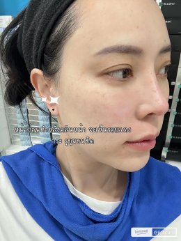 ขอบคุณคุณจูน @jirasuri มากนะครับที่ไว้วางใจให้หมอได้ดูแลปัญหาเรื่องรูขุมขนและจุดด่างดำด้วย โปรแกรม LaserME ครับผม