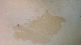 ปานสีน้ำตาล มีลักษณะอย่างไร & ดูแลได้อย่างไร?