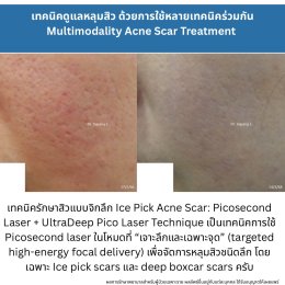 ทำไมต้องใช้เลเซอร์หลายชนิดในการรักษาหลุมสิว แผลเป็น รอยแตกลาย ?