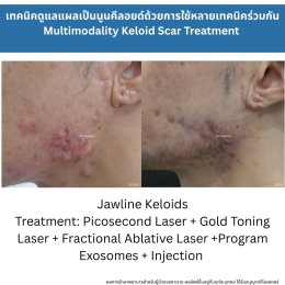 ทำไมต้องใช้เลเซอร์หลายชนิดในการรักษาหลุมสิว แผลเป็น รอยแตกลาย ?