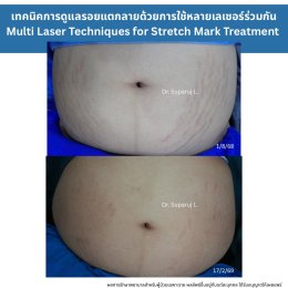 ทำไมต้องใช้เลเซอร์หลายชนิดในการรักษาหลุมสิว แผลเป็น รอยแตกลาย ?