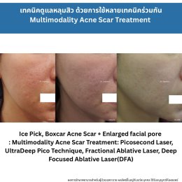 รักษาหลุมสิวแต่พักหน้าไม่ได้ มีวิธีอะไรบ้าง ?