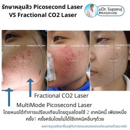 เจาะลึกความแตกต่าง: Fractional CO2 vs Fractional Picosecond Laser ในการรักษาหลุมสิว