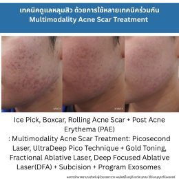 รักษาหลุมสิวแต่พักหน้าไม่ได้ มีวิธีอะไรบ้าง ?