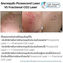 เจาะลึกความแตกต่าง: Fractional CO2 vs Fractional Picosecond Laser ในการรักษาหลุมสิว