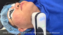 เทคนิค ยกกระชับใบหน้าและคิ้วด้วย เทคนิค Triple-Lined Multifocused Ultrasound