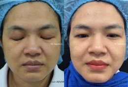 แนะนำโปรแกรมยกกระชับผิวด้วยเลเซอร์ หลายความยาวคลื่น Program Platinum Lifting Multi-Wavelength Laser