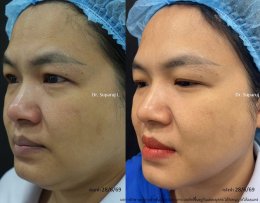 แนะนำโปรแกรมยกกระชับผิวด้วยเลเซอร์ หลายความยาวคลื่น Program Platinum Lifting Multi-Wavelength Laser