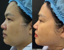 แนะนำโปรแกรมยกกระชับผิวด้วยเลเซอร์ หลายความยาวคลื่น Program Platinum Lifting Multi-Wavelength Laser