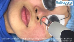 แนะนำโปรแกรม Multimodality & Multilayer Program Discovery Pico VarioPulse Treatment ดูแลปัญหาผิว หลุมสิว แผลเป็น จุดด่างดำ