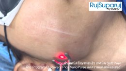 แนะนำเทคนิครักษาหลุมสิว เทคนิค Soft Peel ด้วย Program Discovery Pico VarioPulse ลดความแดงหลังเลเซอร์