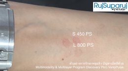 ตัวอย่างการรักษาหลุมสิว ปัญหาเม็ดสีด้วย Multimodality & Multilayer Program Discovery Pico VarioPulse