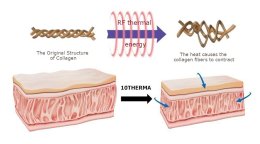 การดูแลความกระชับของผิวด้วย Program XTherma Monopolar RF