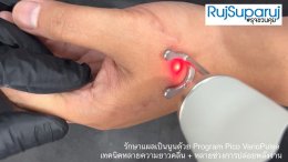 รักษาแผลเป็นนูนด้วย Program Pico VarioPulse เทคนิคหลายความยาวคลื่น + หลายช่วงการปล่อยพลังงาน