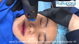การดูแลความกระชับของผิวด้วย Program XTherma Monopolar RF