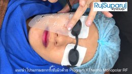 การดูแลความกระชับของผิวด้วย Program XTherma Monopolar RF
