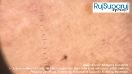 Update เทคนิคดูแลปัญหาฝ้า Melasma Treatment Update