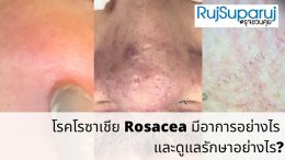 โรคโรซาเชีย Rosacea มีอาการอย่างไร และดูแลรักษาอย่างไร?