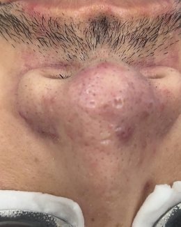 โรคโรซาเชีย Rosacea มีอาการอย่างไร และดูแลรักษาอย่างไร?