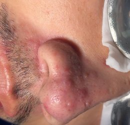 โรคโรซาเชีย Rosacea มีอาการอย่างไร และดูแลรักษาอย่างไร?