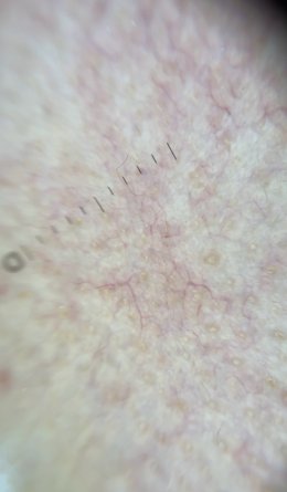 โรคโรซาเชีย Rosacea มีอาการอย่างไร และดูแลรักษาอย่างไร?