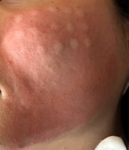 เทคนิคการใช้ Botulinum Toxin และ Microneedling ในการดูแลปัญหารูขุมขนกว้าง สิว และการฟื้นฟูคุณภาพผิว