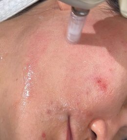 เทคนิคการใช้ Botulinum Toxin และ Microneedling ในการดูแลปัญหารูขุมขนกว้าง สิว และการฟื้นฟูคุณภาพผิว