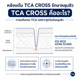 แต้ม TCA CROSS รักษาหลุมสิว รอยแดงและรอยดำ บอกอะไรเราได้บ้างครับ?