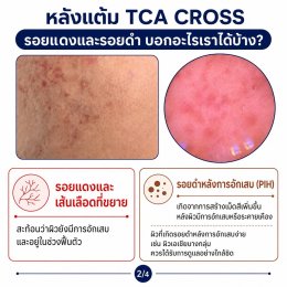 แต้ม TCA CROSS รักษาหลุมสิว รอยแดงและรอยดำ บอกอะไรเราได้บ้างครับ?