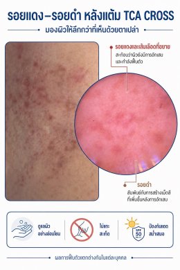 แต้ม TCA CROSS รักษาหลุมสิว รอยแดงและรอยดำ บอกอะไรเราได้บ้างครับ?