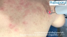 แผลเป็นตุ่นนูนจากสิวที่หลังและลำตัว Papular Acne Scar มีลักษณะอย่างไรดูแลได้อย่างไร ?