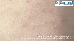 แผลเป็นตุ่นนูนจากสิวที่หลังและลำตัว Papular Acne Scar มีลักษณะอย่างไรดูแลได้อย่างไร ?