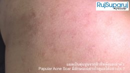 แผลเป็นตุ่นนูนจากสิวที่หลังและลำตัว Papular Acne Scar มีลักษณะอย่างไรดูแลได้อย่างไร ?