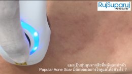 แผลเป็นตุ่นนูนจากสิวที่หลังและลำตัว Papular Acne Scar มีลักษณะอย่างไรดูแลได้อย่างไร ?
