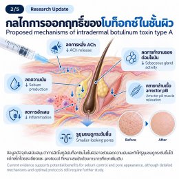 งานวิจัยทบทวน: การฉีด Botulinum Toxin Type A ในชั้นผิวเพื่อช่วยลดความมันและรูขุมขนกว้าง