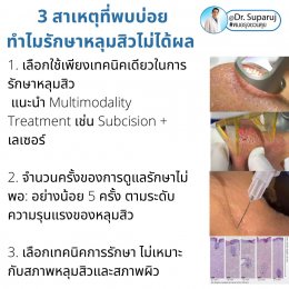 แนะนำเทคนิคดูแลหลุมสิว: เทคนิคดูแลหลุมสิวที่หมอรุจใช้บ่อย Multimodality Acne Scar Treatment Approach