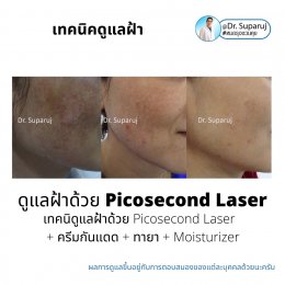 เทคนิคดูแลฝ้าด้วย Picosecond Laser